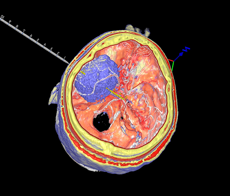 Fusion-of-Tumor-CT-and-MRI.jpg