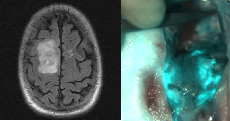 Adult-Brain_MRI-Intraop.jpg