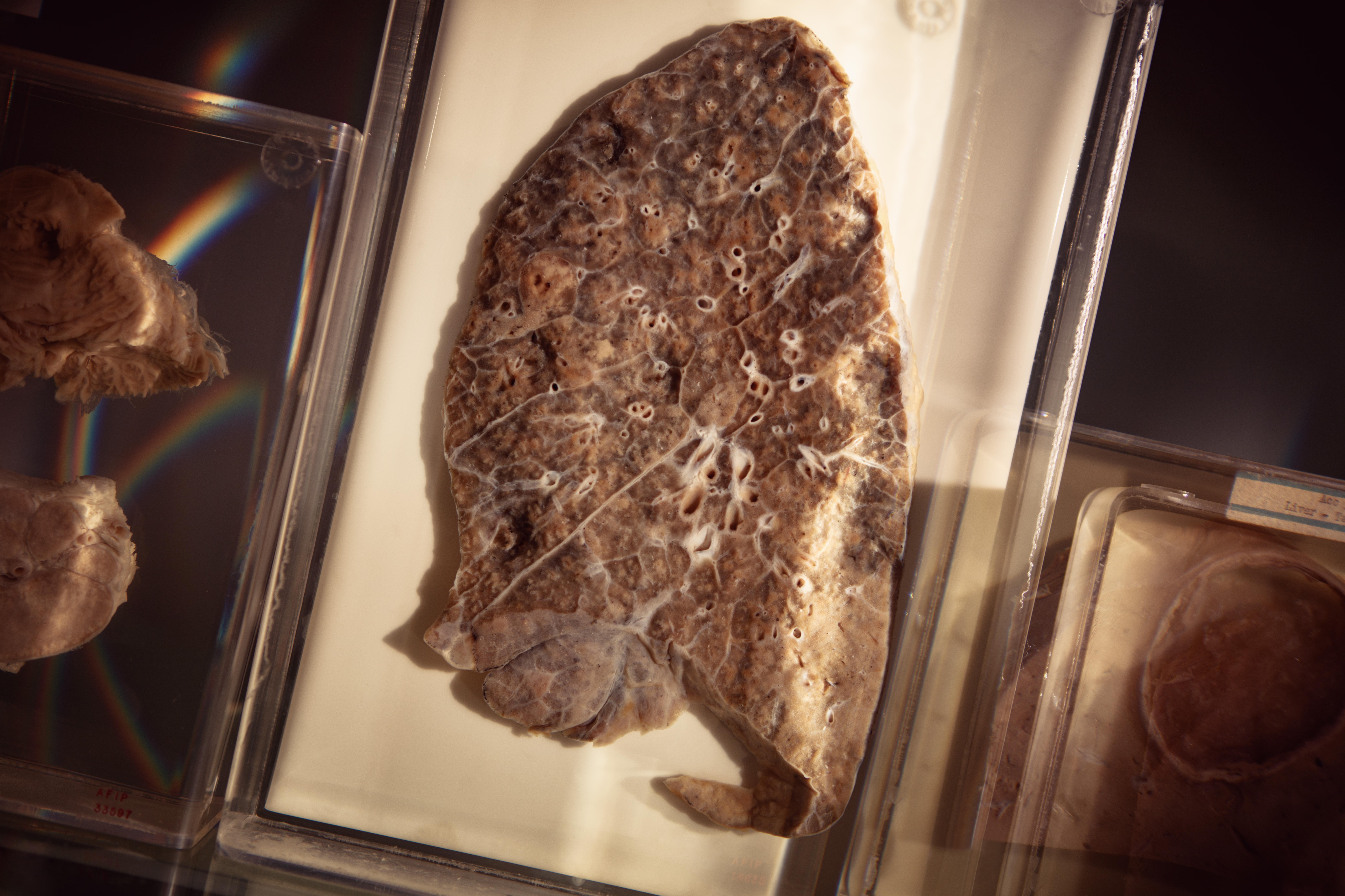 a ravaged lung at the national museum of health and medicine from a u s soldier killed by flu in 1918 cade martin a ravaged lung at the national museum of health and medicine from a u s soldier killed by flu in 1918 cade martin