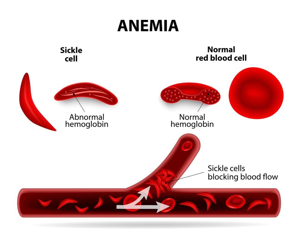 Sickle Cell Gene